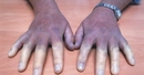 Raynaud Hastalığı Belirtileri ve Tedavisi Raynaud Hastalığı Belirtileri ve Tedavisi