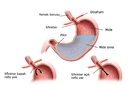 Reflü Hastalığı Belirtileri ve Tedavisi Reflü Hastalığı Belirtileri ve Tedavisi