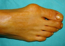 Kemik Büyümesi Hastalığı Belirtileri ve Tedavisi Kemik Büyümesi Hastalığı Belirtileri ve Tedavisi