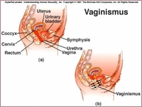 Vajinismus Hastalığı Belirtileri ve Tedavisi Vajinismus Hastalığı Belirtileri ve Tedavisi