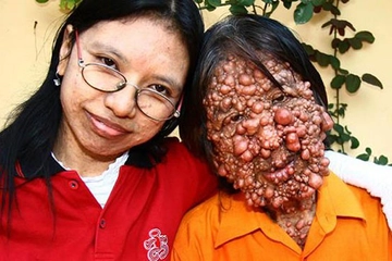 Porfiria Hastalığı Belirtileri ve Tedavisi