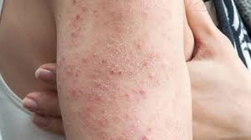 Yılancık Hastalığı Belirtileri ve Tedavisi Yılancık Hastalığı Belirtileri ve Tedavisi